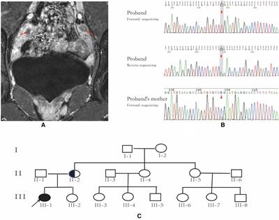 Complete androgen insensitivity syndrome coexisting with müllerian duct remnants: a case report and literature review